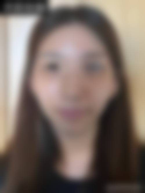 临床实例分享:济南瑞韩整形医疗美容单良