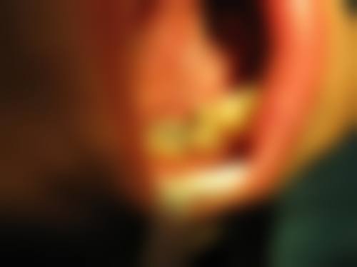 临床实例分享:重庆皇仕德亚口腔门诊部赵吉庆