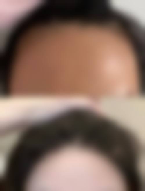 临床实例分享:找高健医生能达到理想成效吗?
