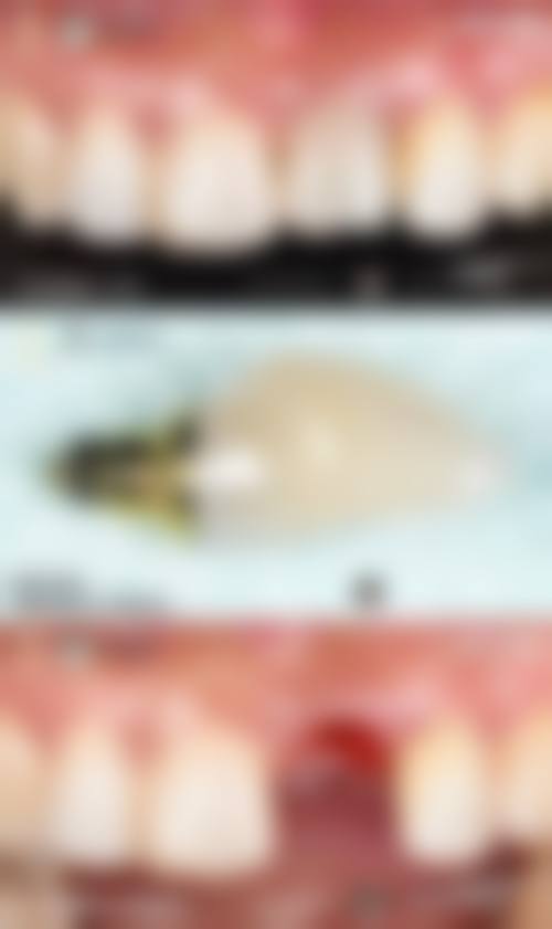 普通洗牙:80-150元/次